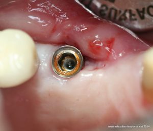پیامدهای دکتر ادیب در استفاده از ایمپلنت دندان