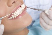 دکتر آزادمنش: چه افرادی کاندید لمینیت دندانی هستند؟