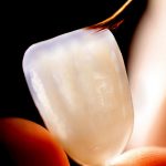 دکتر نظری: آیا لمینت دندان دشوار است؟