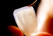 دکتر نظری: آیا لمینت دندان دشوار است؟