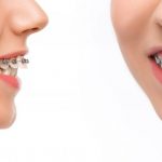 دکتر منیره تهرانی: مرتب کردن ظاهر دندان ها با استفاده از ارتودنسی