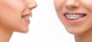 دکتر منیره تهرانی: مرتب کردن ظاهر دندان ها با استفاده از ارتودنسی