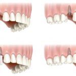 سوالات رایج در مورد ایمپلنت دندانپزشکی نارمک