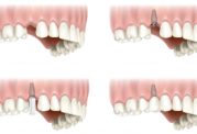 سوالات رایج در مورد ایمپلنت دندانپزشکی نارمک