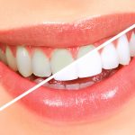 دکتر ژاله کارامد: با سفید کردن دندان ها طرح لبخندی زیبا داشته باشید