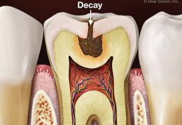 4 توصیه برای پیشگیری از پوسیدگی دندان