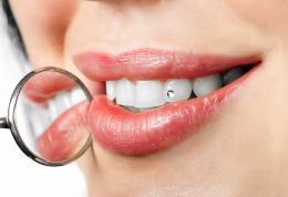 نصب نگین روی دندان باعث پوسیدگی شدید دندان می شود
