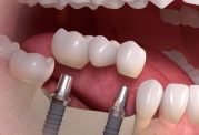 دکتر نظری: پرسش و پاسخ درباره ایمپلنت دندان