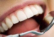 بررسی مهم ترین علائم پوسیدگی دندان
