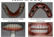دکتر ترنگ آقابیگی: بررسی ویژگی ها و مزایای مختلف ایمپلنت دندان