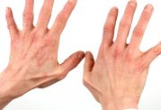 علائم مختلف بیماری روی دستان
