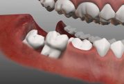 چرا باید دندان عقل نیمه نهفته را جراحی کنیم؟