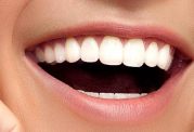 اطلاعاتی در مورد روکش دندان