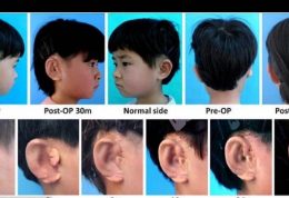 ساخت گوش برای 5 کودک چینی با روش نوین