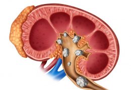 هر آنچه باید در مورد سنگ کلیه بدانید