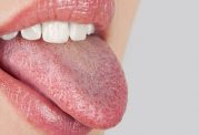 علت بروز بیماری خشکی زبان و دهان