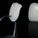 کلینیک آلما: آشنایی با لمينت سرامیکی دندان