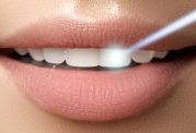 لمینت دندان و بررسی نحوه استفاده از آن در دندانپزشکی زیبایی کلینیک آلما