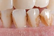 علت ایجاد لکه روی دندان چیست