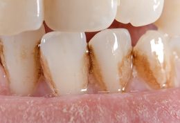 علت ایجاد لکه روی دندان چیست