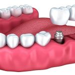 دکتر پیمان کریمیها: ایمپلنت های دندانی