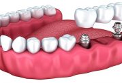 دکتر پیمان کریمیها: ایمپلنت های دندانی