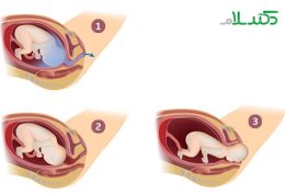 وضعیت جنین در رحم مادر + تشخیص و اصلاح موقعیت آن