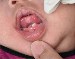 دندان داشتن نوزاد هنگام تولد