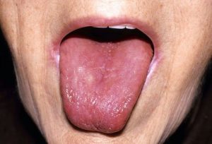 زبان صاف و کمبود ویتامین B12