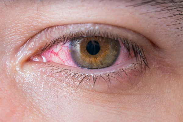 چگونه بیماری چشم صورتی را در منزل درمان کنیم؟