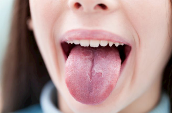 سوختگی زبان