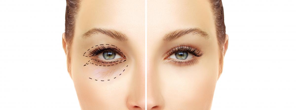 جراحی پلک چشم یا بلفاروپلاستی