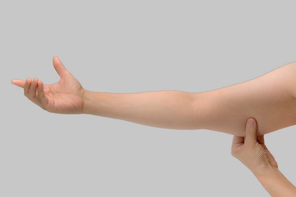 لیفت بازو یا براکیوپلاستی چیست؟