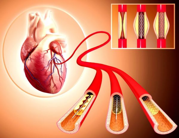 استنت گذاری سیاهرگ های مسدود شده + راهنمایی کامل