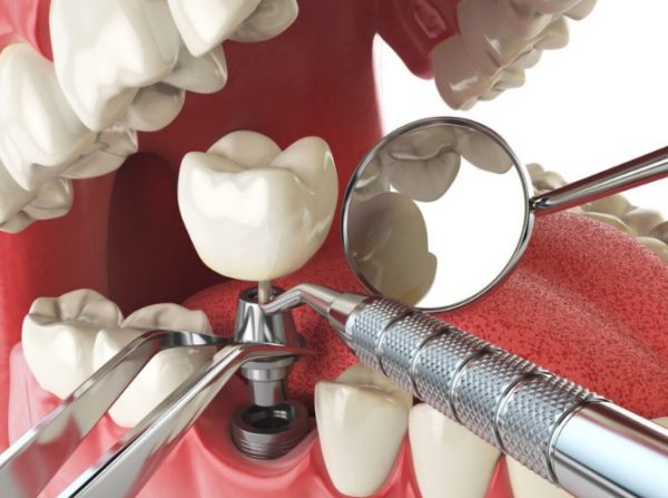 بریج دندان در مقابل ایمپلنت دندان