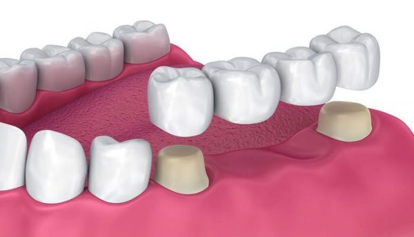 بریج دندان در مقابل ایمپلنت دندان