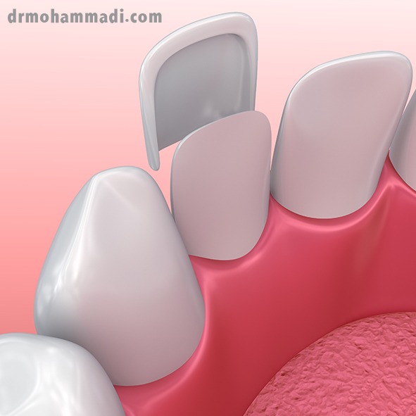 ونیر لمینت دندان یا لیمینت سرامیکی چیست؟