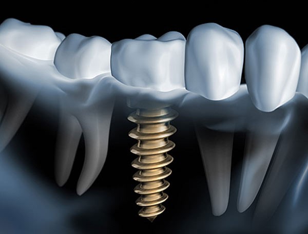 ایمپلنت دندان چیست؟ ایمپلنت های دندان چگونه عمل می کنند؟
