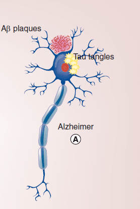 نقش سلول‌های بنیادی مزانشیمی بافت بند ناف در درمان آلزایمر