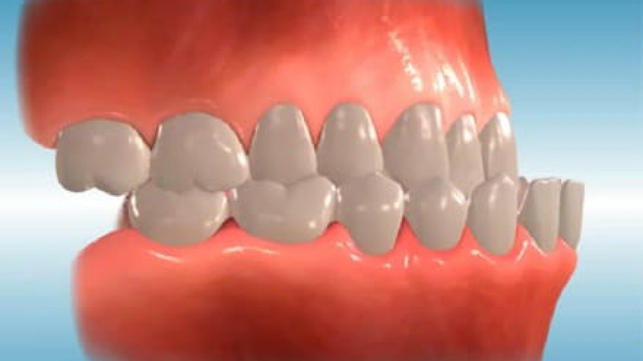 نسبت فک ها و کلاس های مختلف تماس در دندان ها و فک بالا و پایین