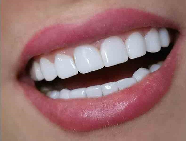کامپوزیت دندان چیست؟ + انواع کامپوزیت ، مزیت ها و معایب