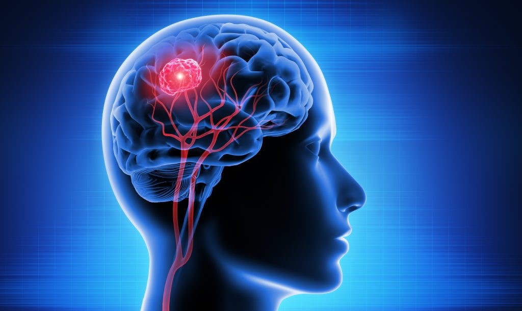 شایع ترین تومور های مغزی کدامند؟ + روش های درمان