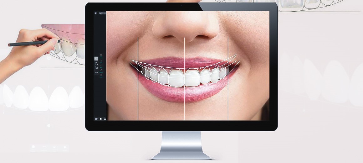 چرا ایمپلنت دیجیتال برای رفع مشکل بی دندانی مناسب است ؟