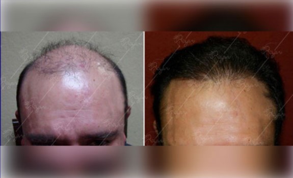 آیا کاشت مو می تواند ریزش ژنتیکی مو را درمان کند؟