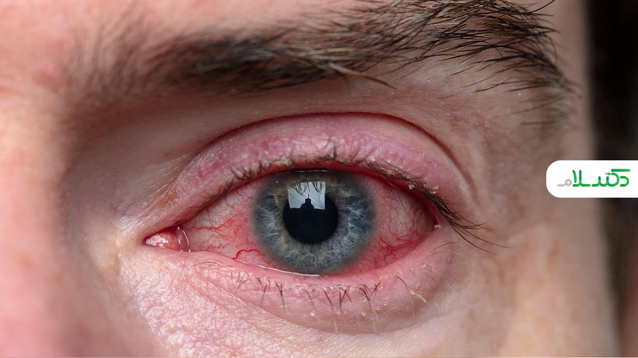دلایل به وجود آمدن حلقه قرمز اطراف چشم چیست؟