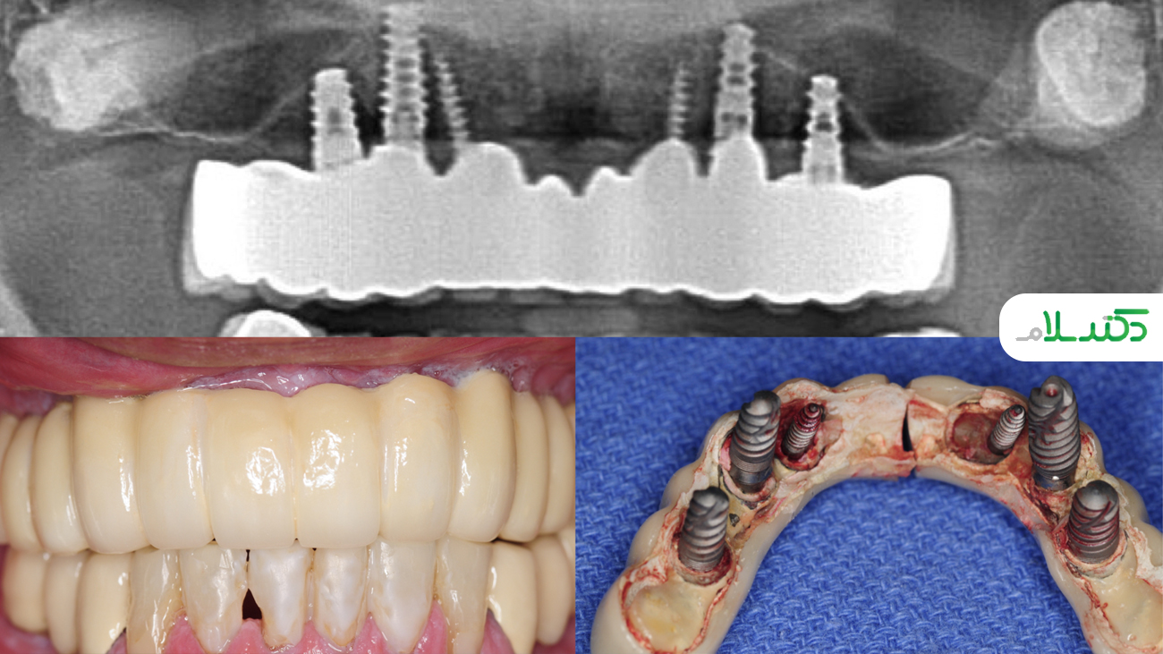 آیا برای کاشت ایمپلنت دندان، نیاز شرایط بدنی و دهانی مناسب است؟