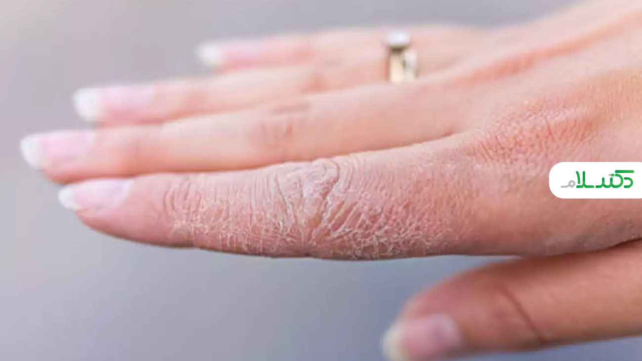چه دلایلی باعث کنده شدن پوست دست ها می شود؟