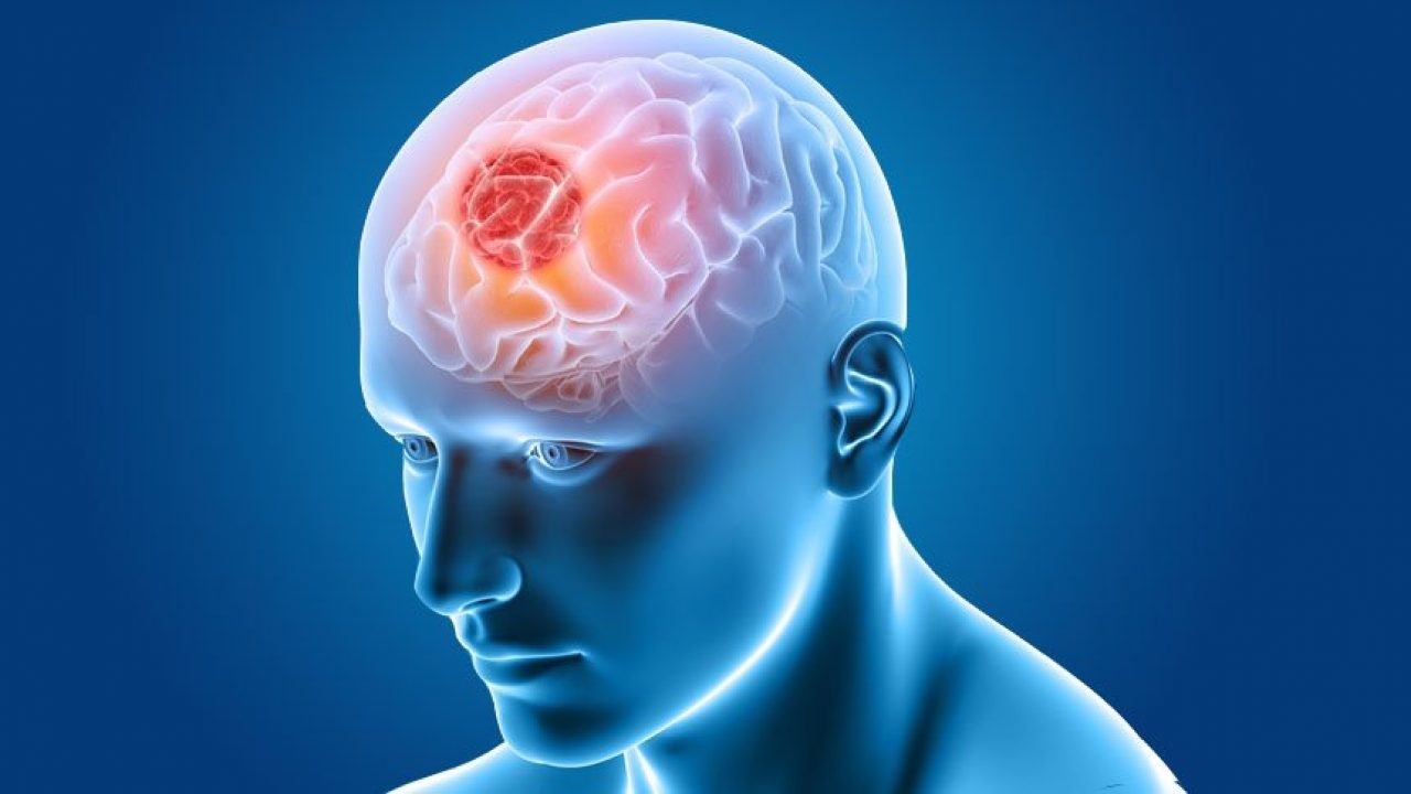 جراحی تومور مغزی توسط جراح مغز و اعصاب