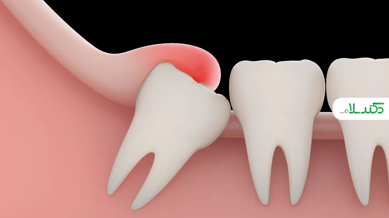 هر چیزی که باید درباره دندان عقل بدانید