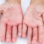 چه عواملی باعث پوست پوست شدن دست ها می شوند؟